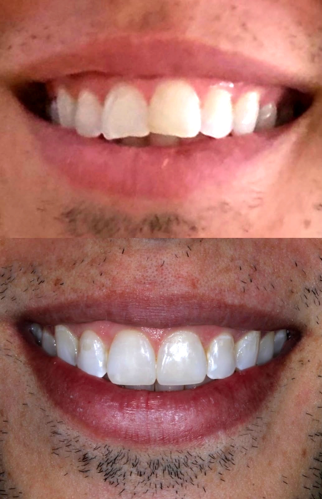 Caso clínico — Clareamento, Resina estética e Invisalign
