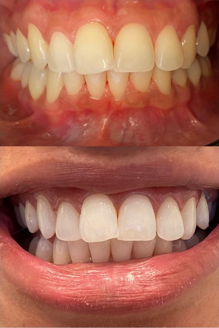 Antes e depois — alinhamento dental e clareamento