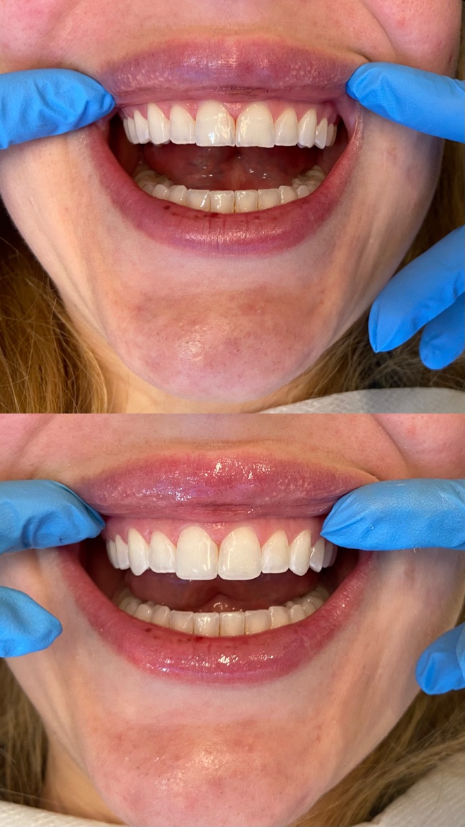 Antes e depois — sorriso feminino com alinhamento