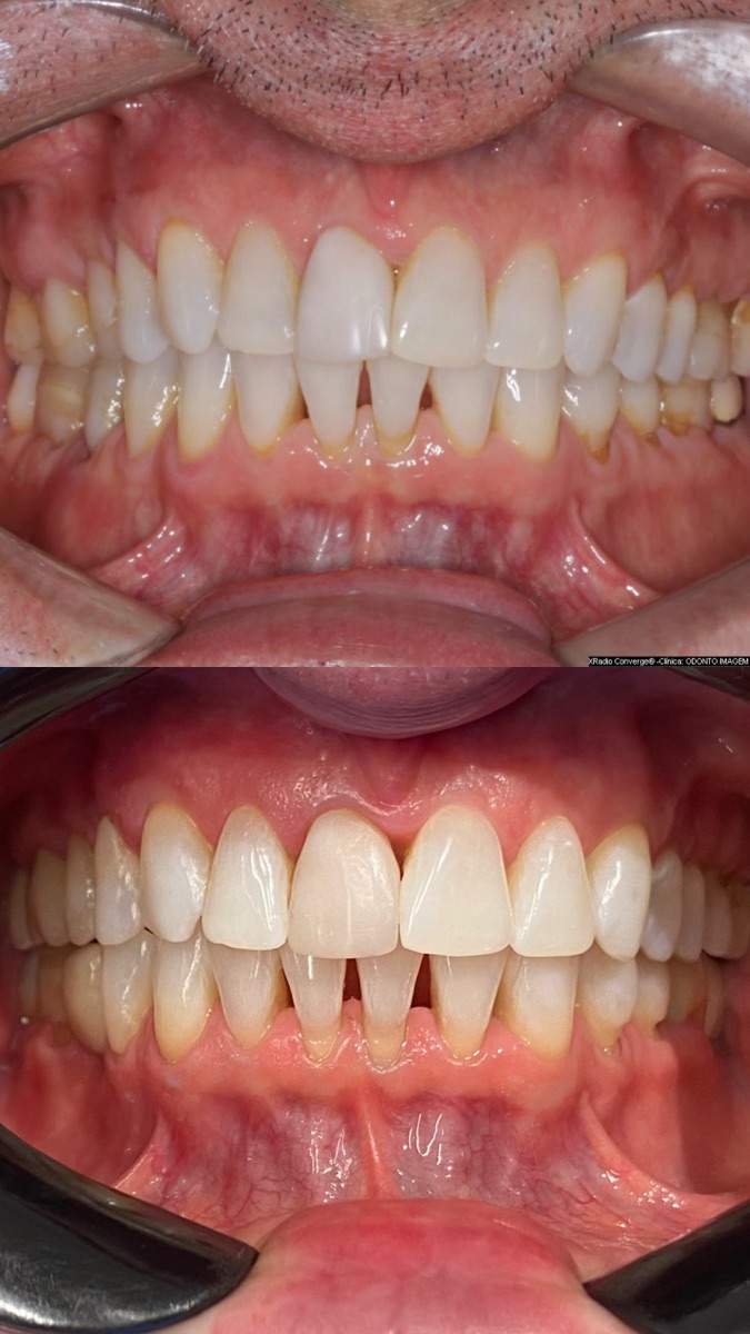 Antes e depois — alinhamento frontal com ortodontia